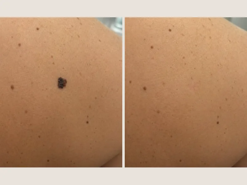 Lunar en la espalda de una persona atendida en la clínica, antes y después de su extirpación