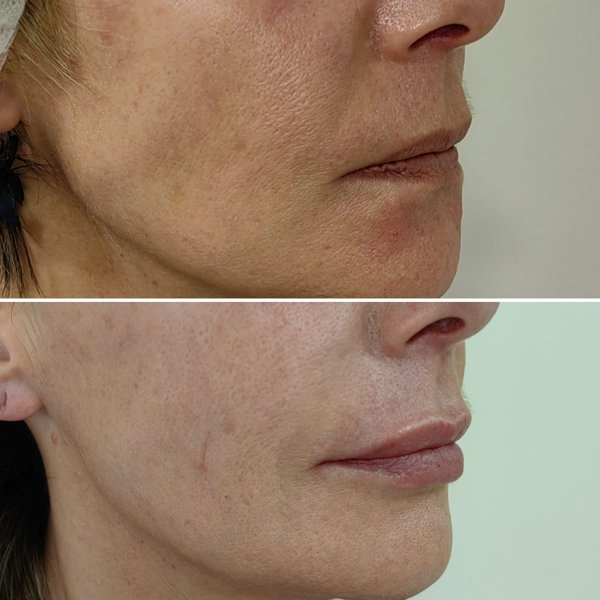 Labios de una paciente de la clínica antes y después de un perfilado con ácido hialurónico